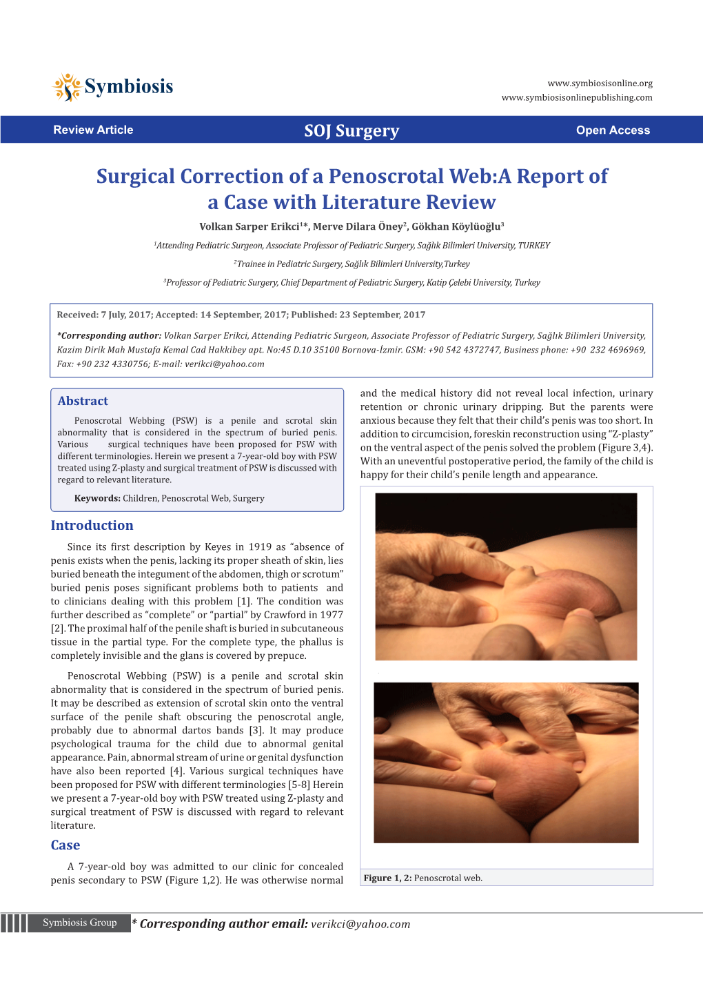 Surgical Correction of a Penoscrotal Web:A Report of a Case With