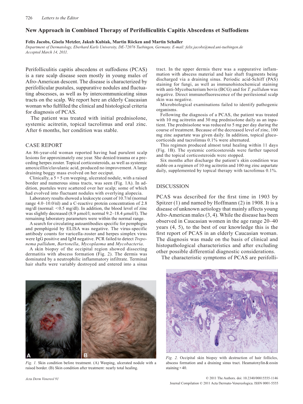 New Approach in Combined Therapy of Perifolliculitis Capitis Abscedens Et Suffodiens