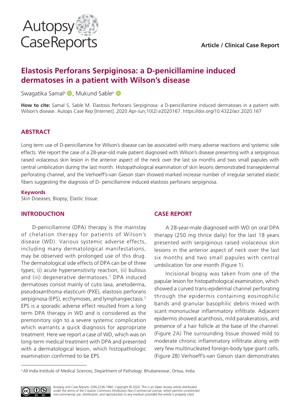 Elastosis Perforans Serpiginosa: a D-Penicillamine Induced Dermatoses in a Patient with Wilson’S Disease