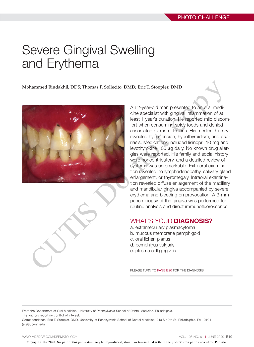 Severe Gingival Swelling and Erythema