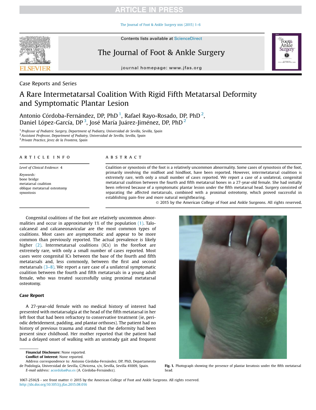 A Rare Intermetatarsal Coalition with Rigid Fifth Metatarsal Deformity and Symptomatic Plantar Lesion