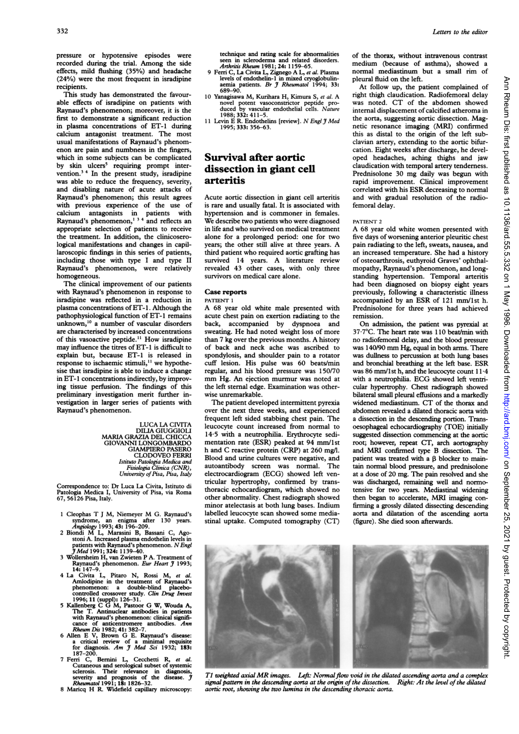 Survival After Aortic Dissection in Giant Cell Arteritis