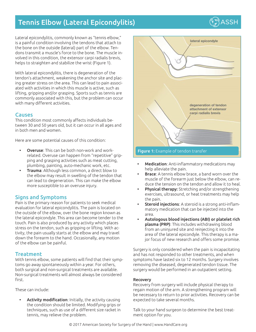 Tennis Elbow (Lateral Epicondylitis)