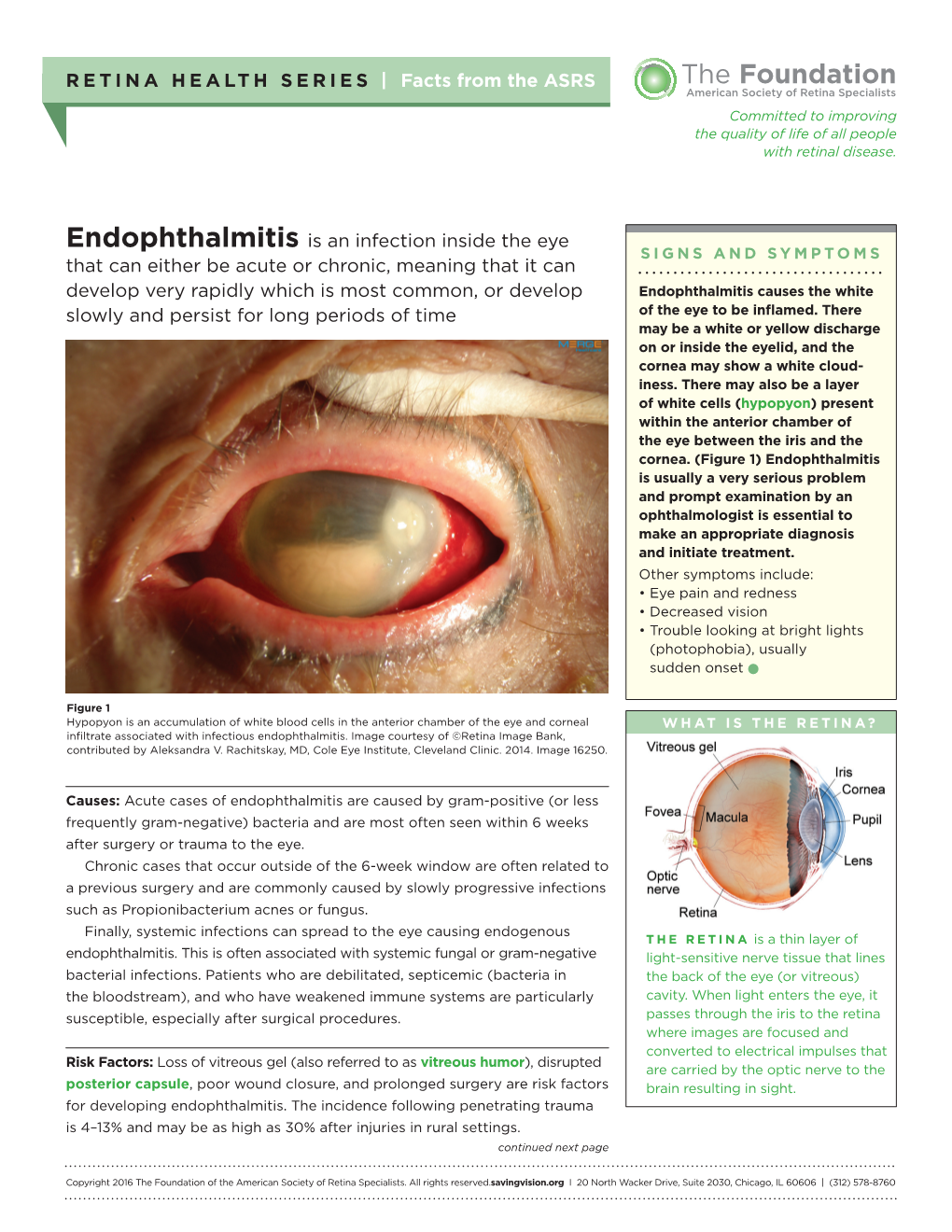 Endophthalmitis