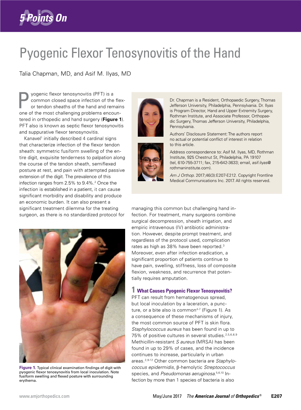 Pyogenic Flexor Tenosynovitis of the Hand