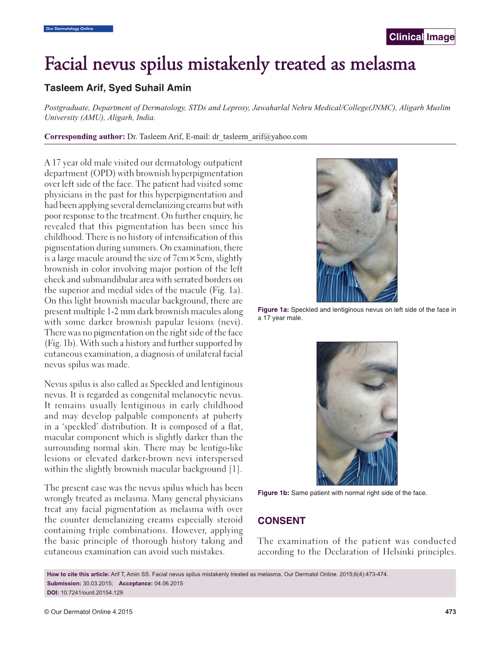 Facial Nevus Spilus Mistakenly Treated As Melasma Tasleem Arif, Syed Suhail Amin