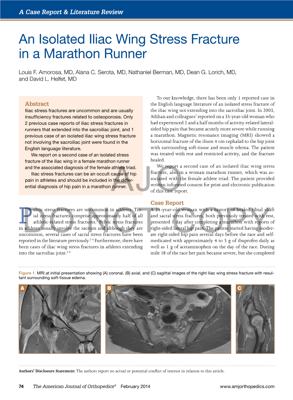 An Isolated Iliac Wing Stress Fracture in a Marathon Runner