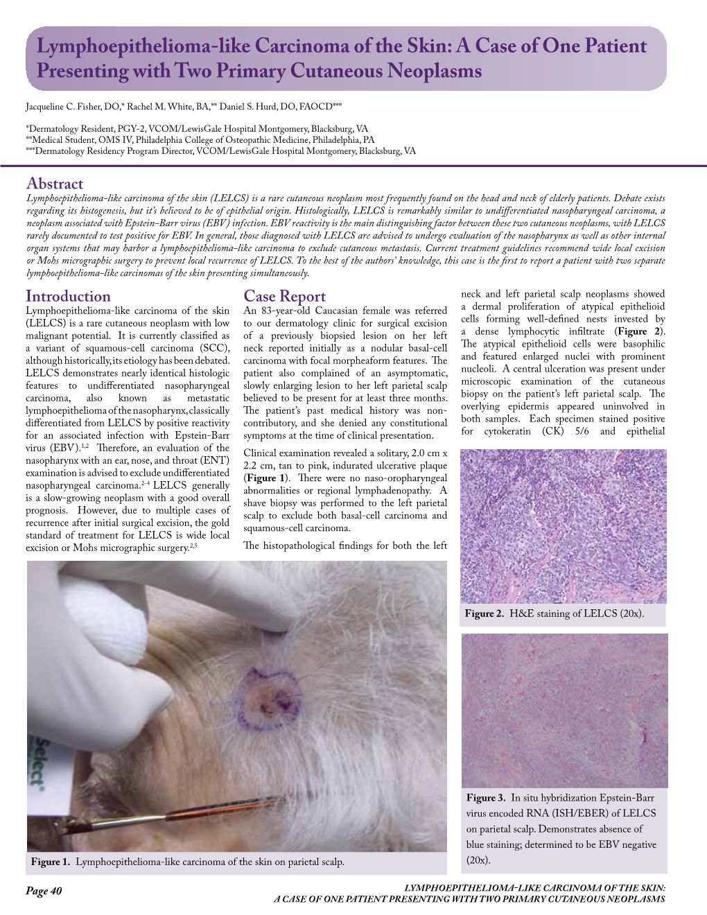 Lymphoepithelioma-Like Carcinoma of the Skin: a Case of One Patient Presenting with Two Primary Cutaneous Neoplasms