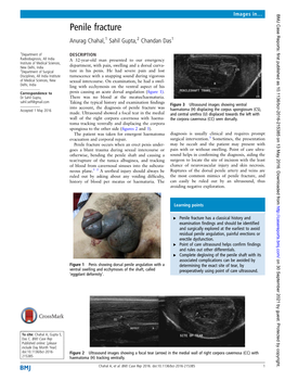 Penile Fracture Anurag Chahal,1 Sahil Gupta,2 Chandan Das1