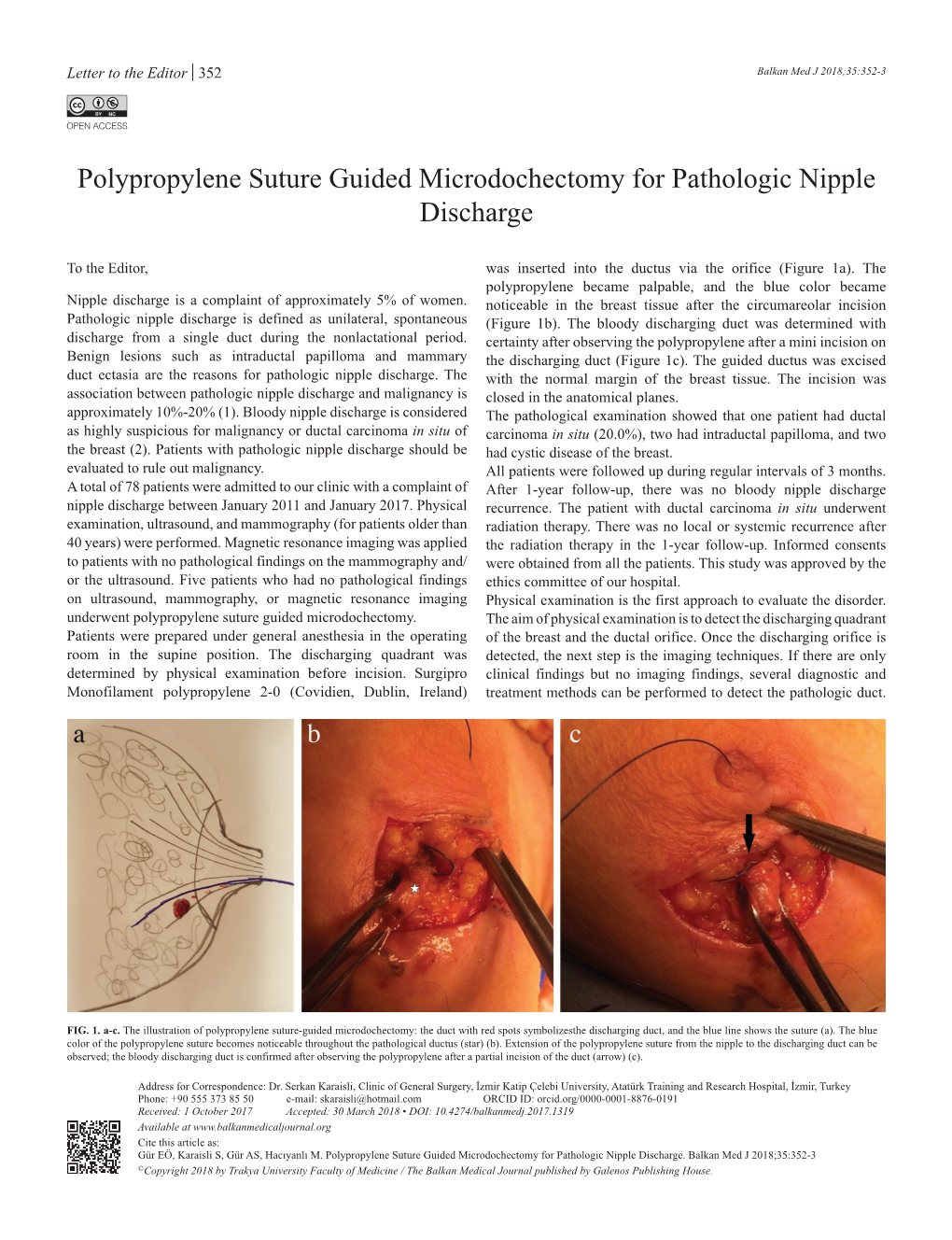 Polypropylene Suture Guided Microdochectomy for Pathologic Nipple Discharge