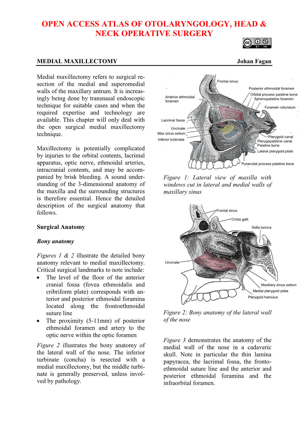 MEDIAL MAXILLECTOMY Johan Fagan