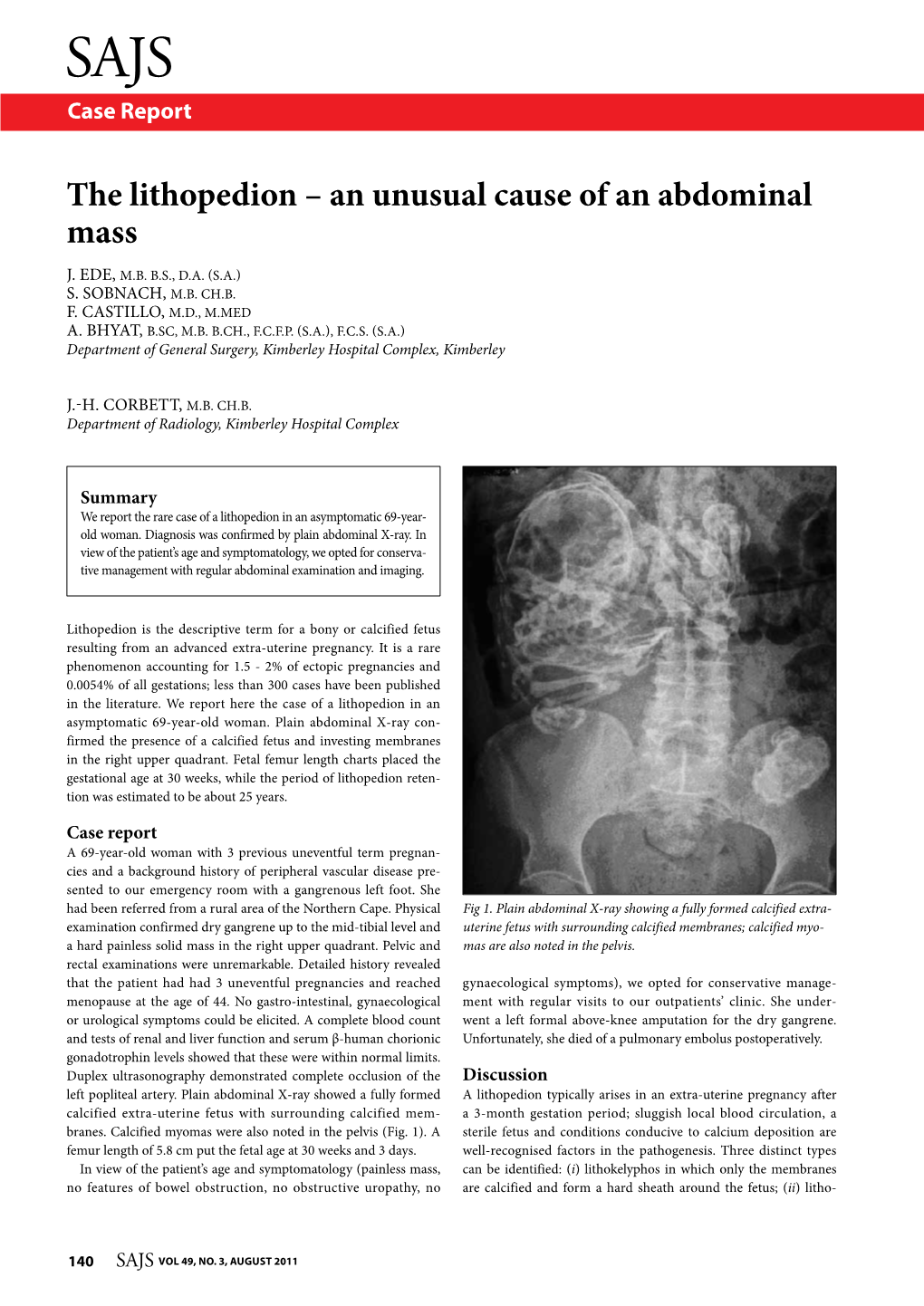 The Lithopedion – an Unusual Cause of an Abdominal Mass