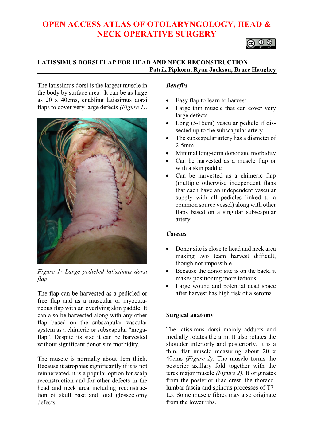 LATISSIMUS DORSI FLAP for HEAD and NECK RECONSTRUCTION Patrik Pipkorn, Ryan Jackson, Bruce Haughey