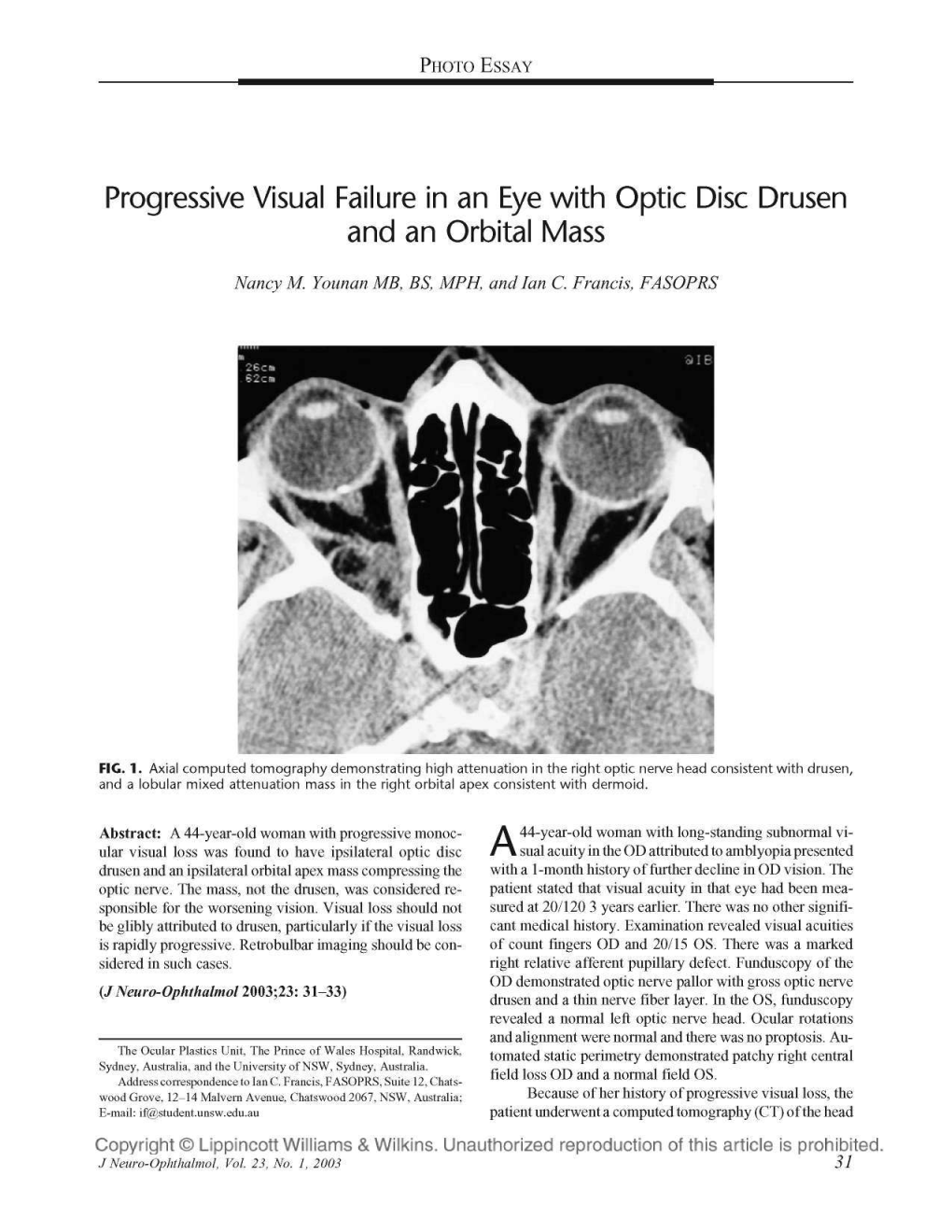 Progressive Visual Failure in an Eye with Optic Disc Drusen and an Orbital Mass