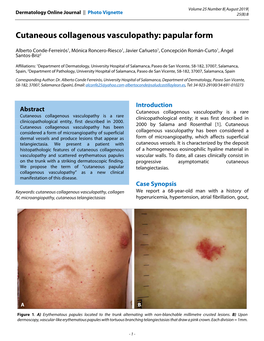 Cutaneous Collagenous Vasculopathy: Papular Form