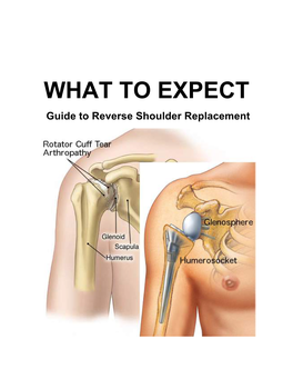 Guide to Reverse Shoulder Replacement TABLE of CONTENTS