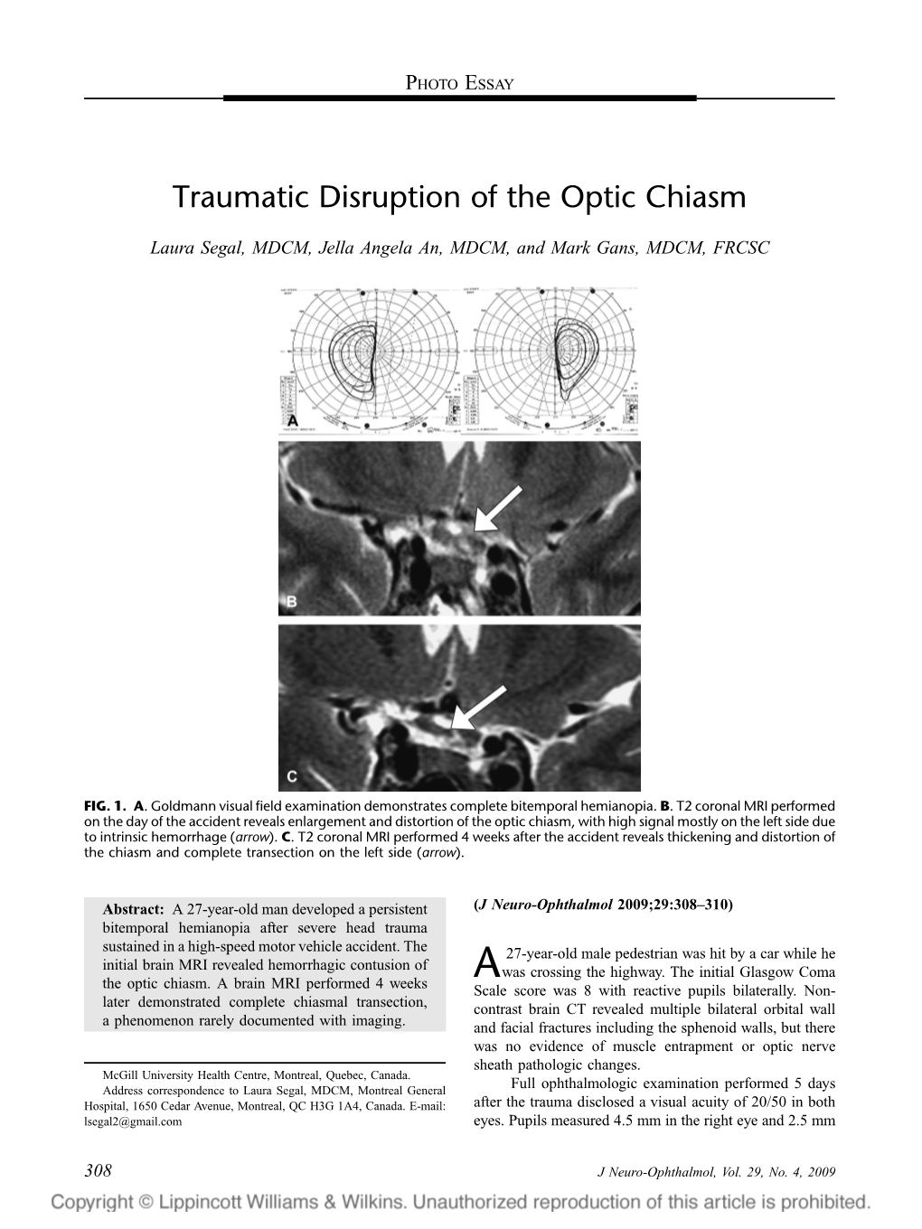 Traumatic Disruption of the Optic Chiasm