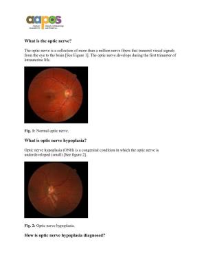 What Is Optic Nerve Hypoplasia?