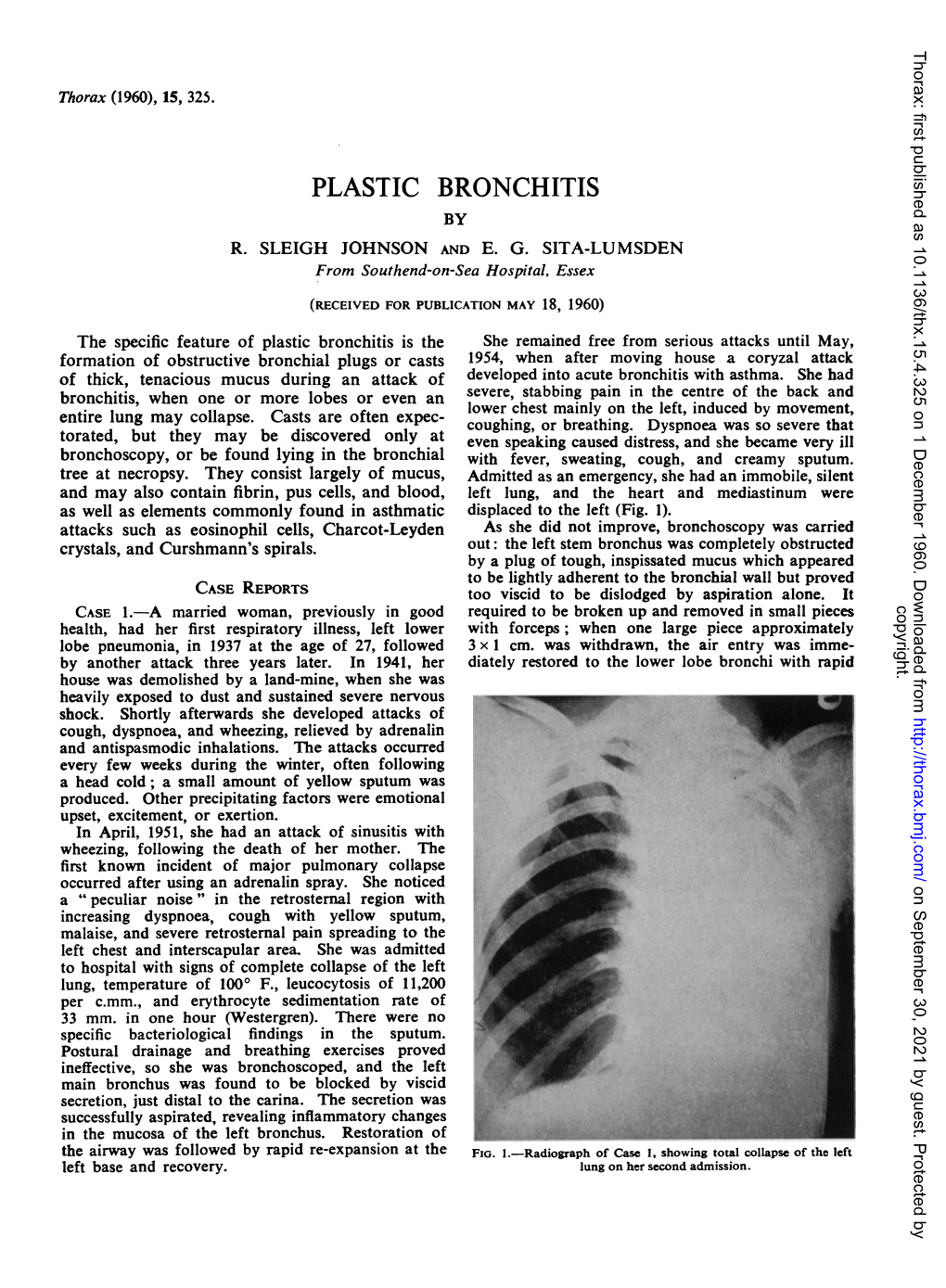 Plastic Bronchitis by R