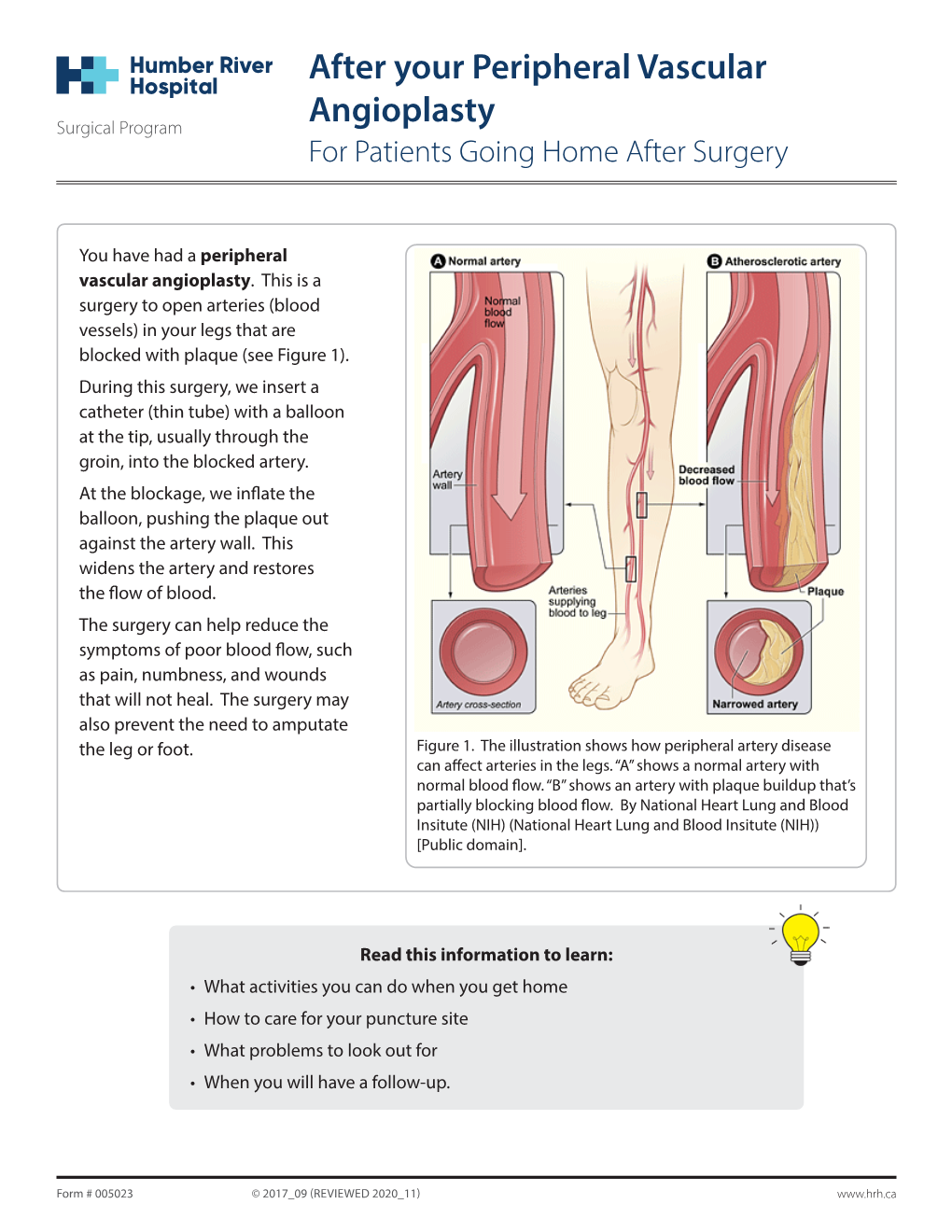 After Your Peripheral Vascular Angioplasty”, with Permission from the University Health Network Patient and Caregiver Education Program