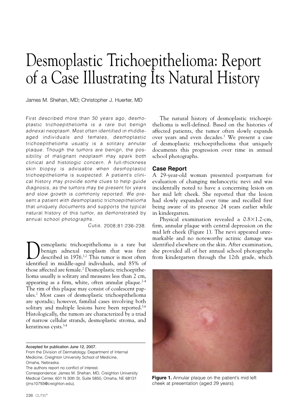 Desmoplastic Trichoepithelioma: Report of a Case Illustrating Its Natural History