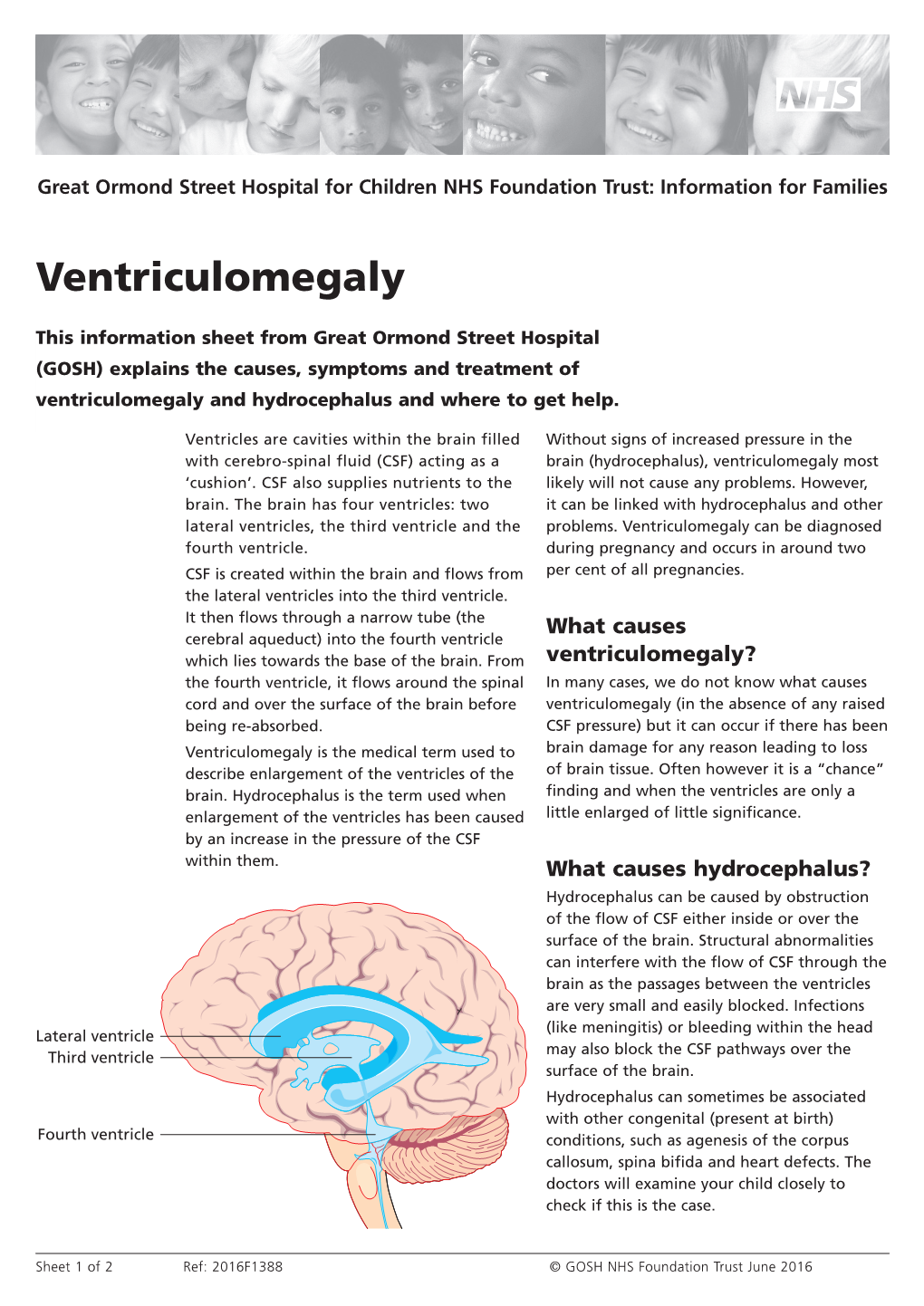 Ventriculomegaly