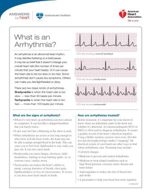 What Is an Arrhythmia?