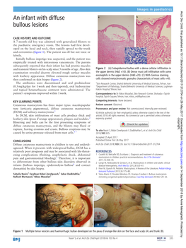 An Infant with Diffuse Bullous Lesions