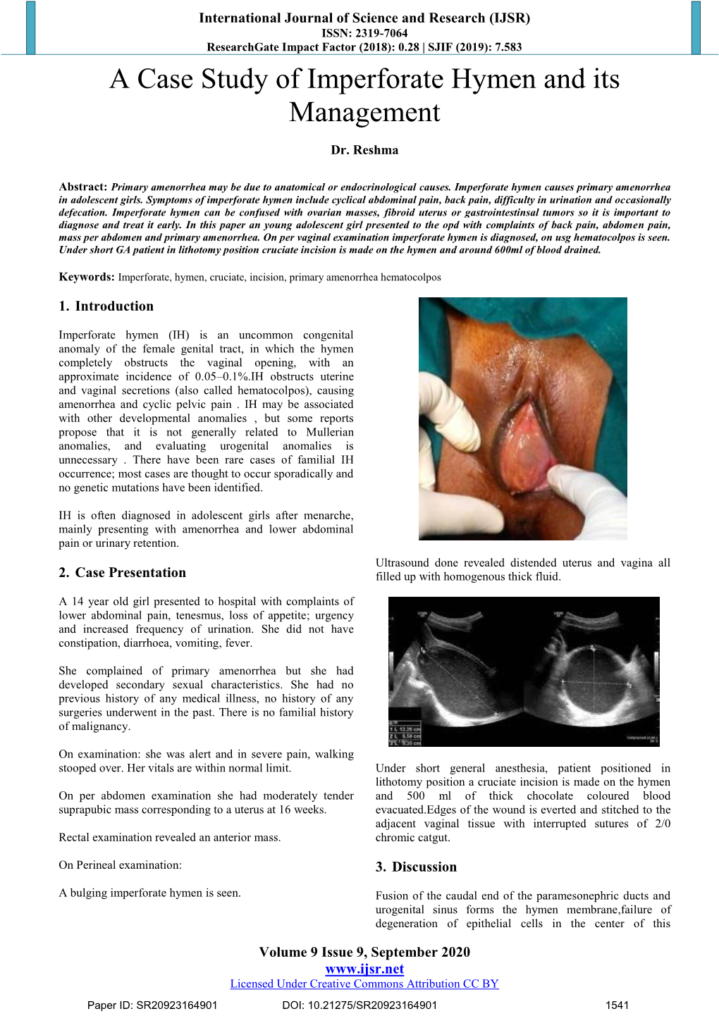 A Case Study of Imperforate Hymen and Its Management