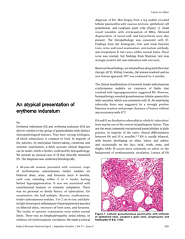 An Atypical Presentation of Erythema Induratum