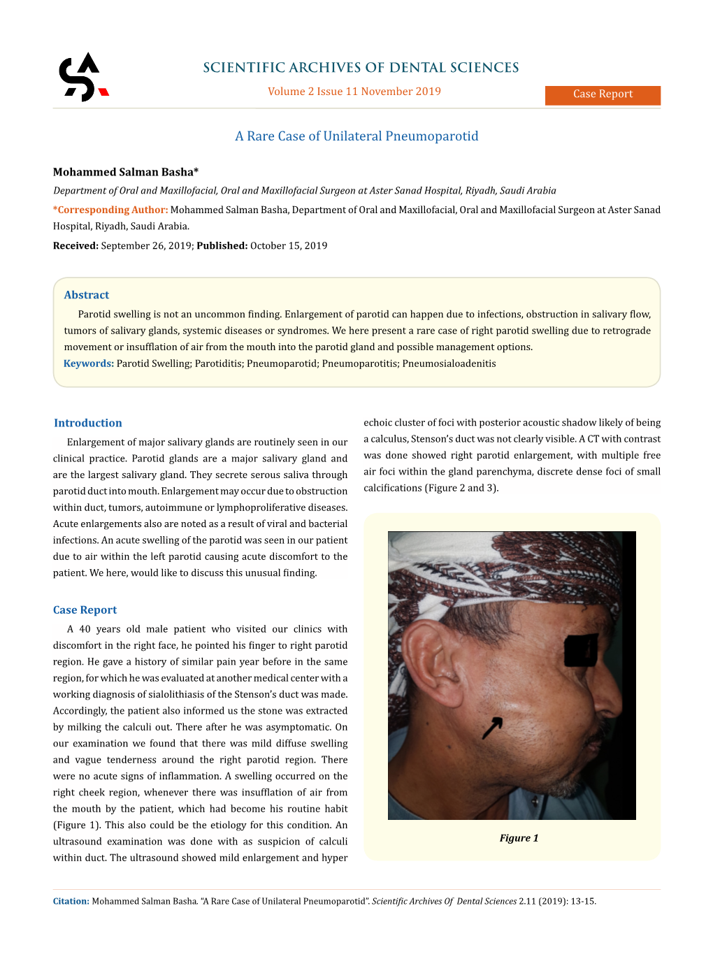 A Rare Case of Unilateral Pneumoparotid