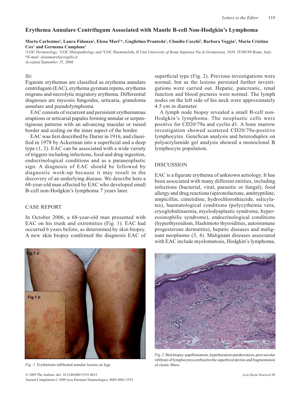 Erythema Annulare Centrifugum Associated with Mantle B-Cell Non-Hodgkin’S Lymphoma