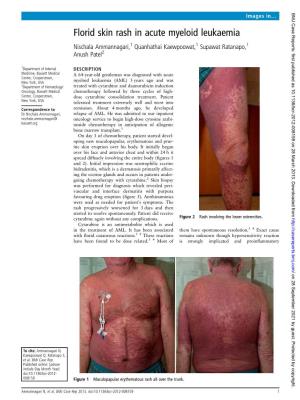 Florid Skin Rash in Acute Myeloid Leukaemia Nischala Ammannagari,1 Quanhathai Kaewpoowat,1 Supawat Ratanapo,1 Anush Patel2