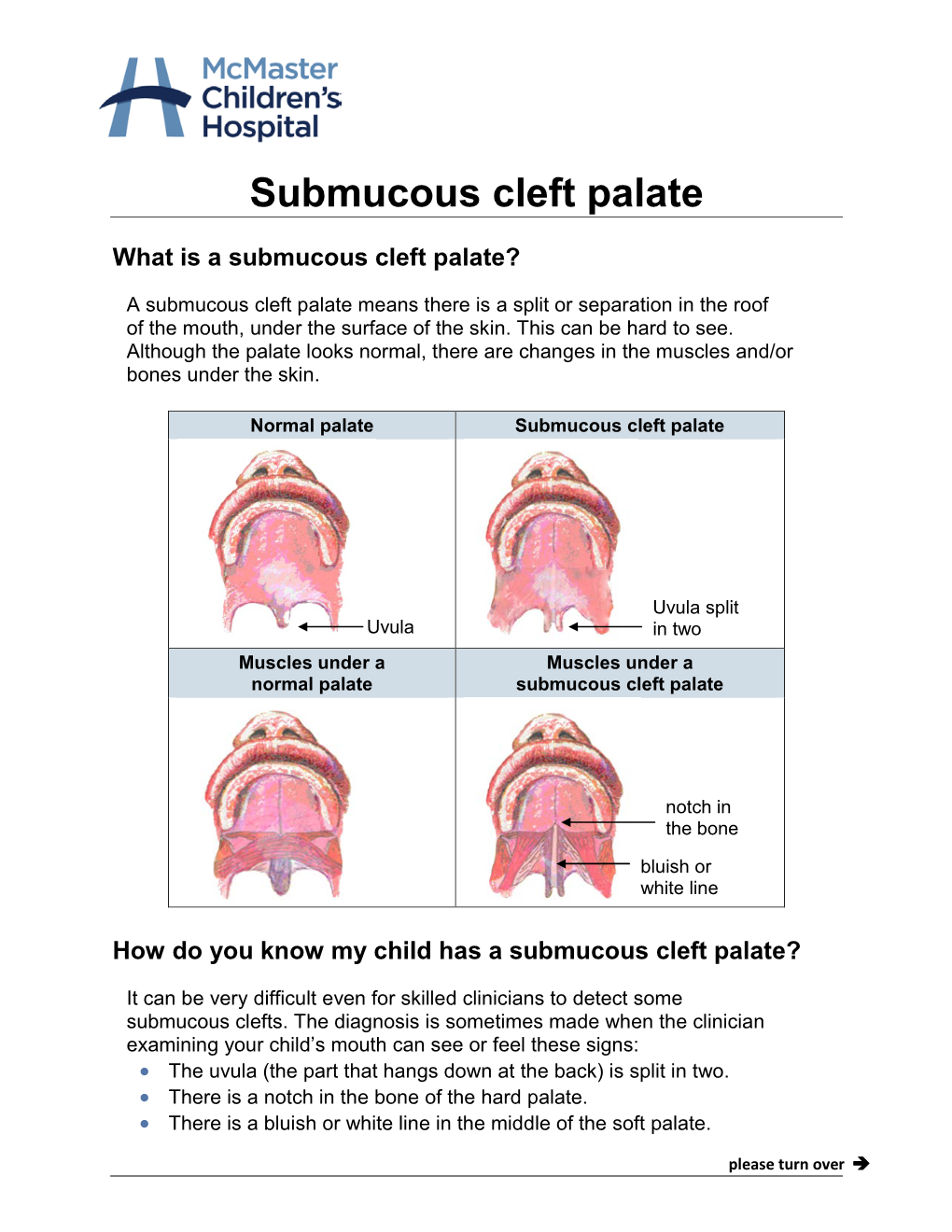 An Explanation of Submucous Cleft Palate