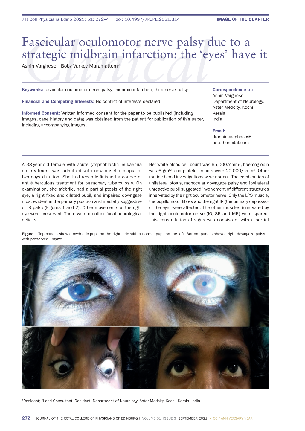 Fascicular Oculomotor Nerve Palsy Due to a Strategic Midbrain Infarction: the ‘Eyes’ Have It Ashin Varghese1, Boby Varkey Maramattom2