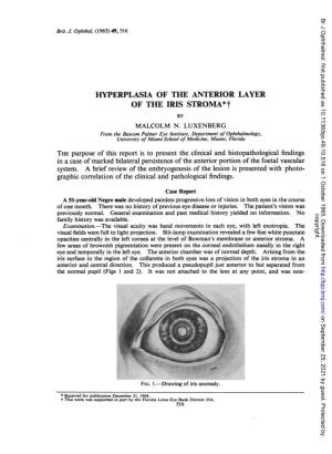 HYPERPLASIA of the ANTERIOR LAYER of the IRIS STROMA*T by MALCOLM N