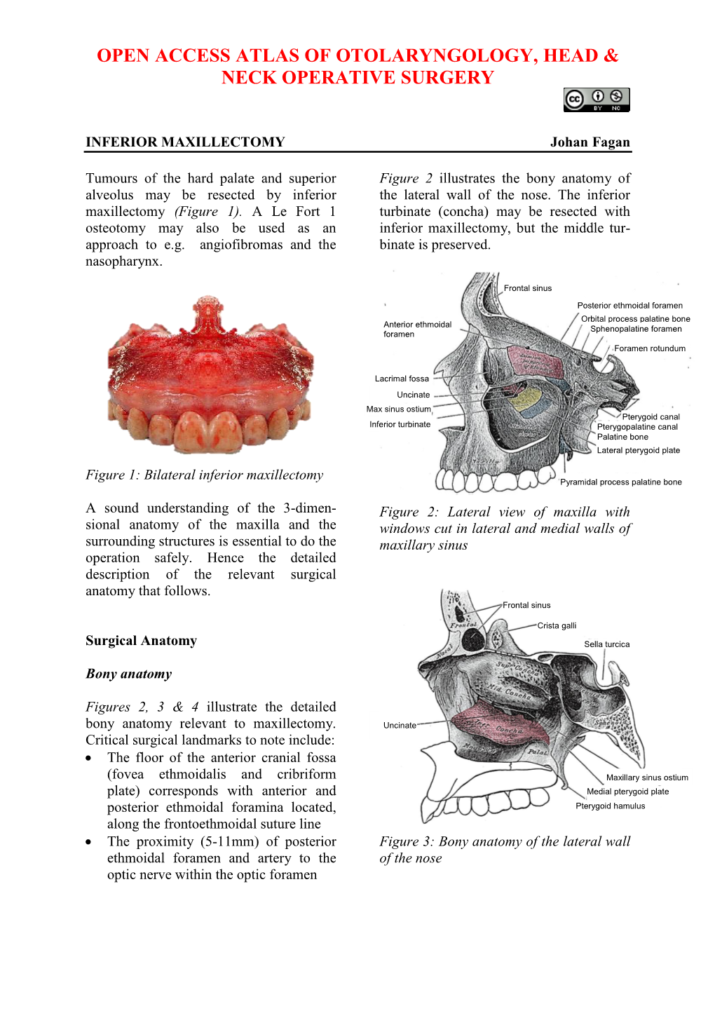 INFERIOR MAXILLECTOMY Johan Fagan