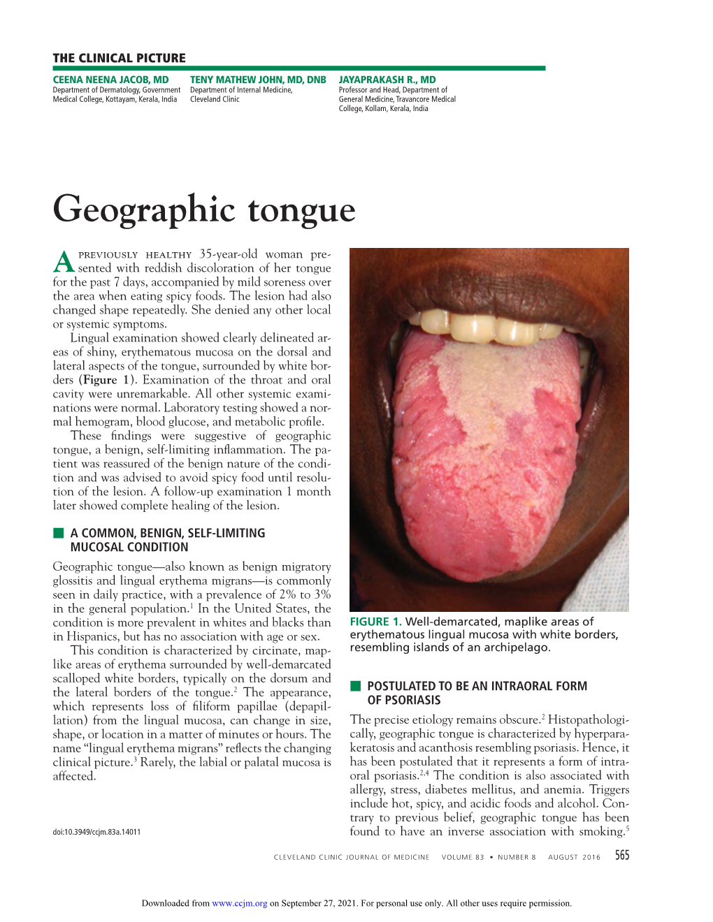 Geographic Tongue