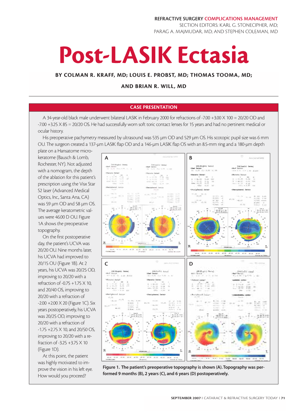 Post-LASIK Ectasia by COLMAN R