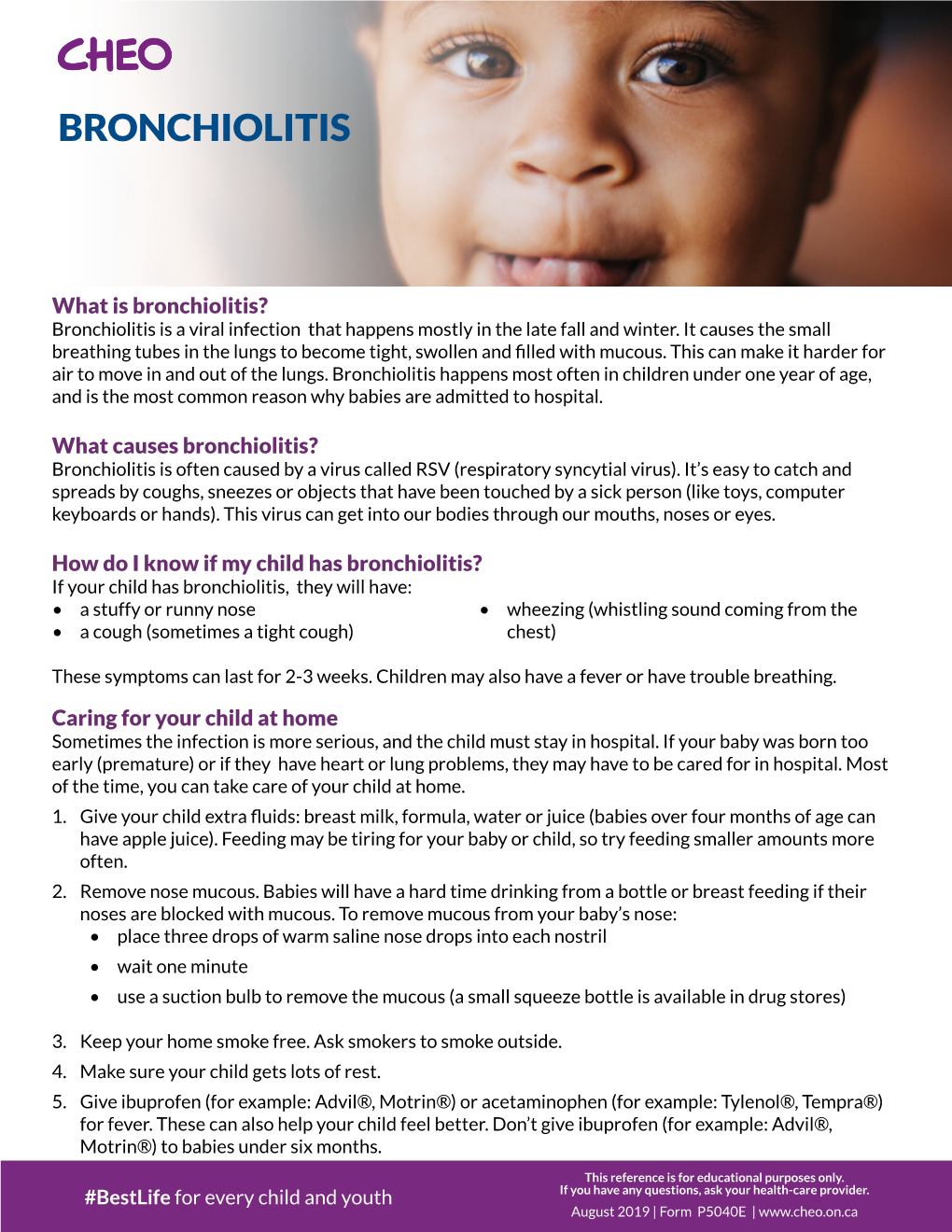 Bronchiolitis