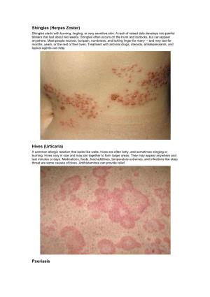 Shingles (Herpes Zoster) Hives (Urticaria) Psoriasis