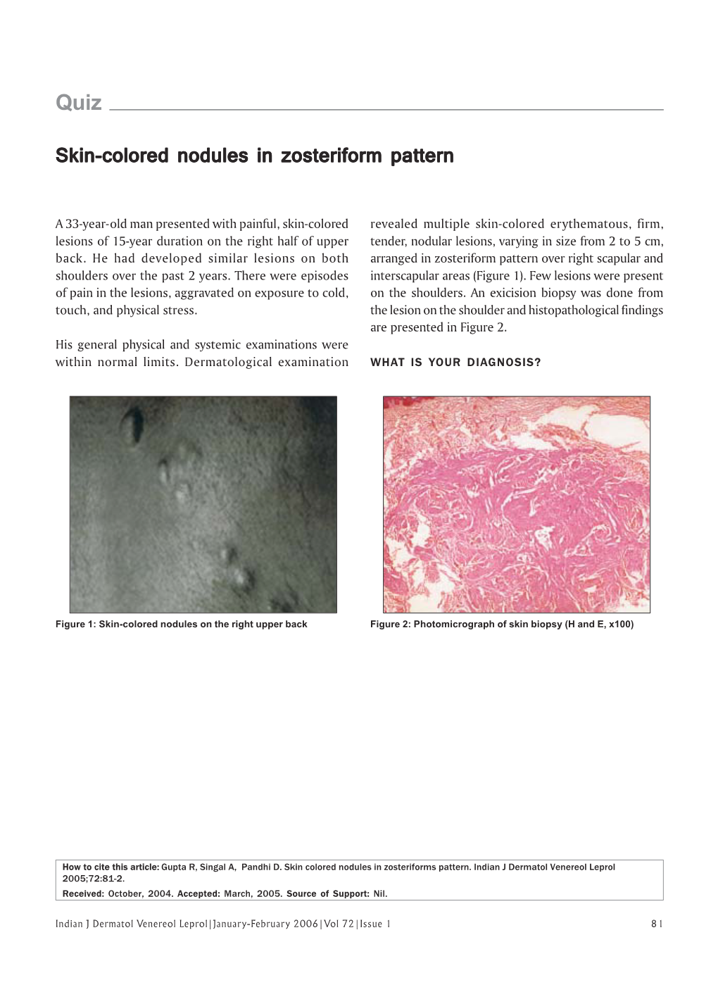 Skin-Colored Nodules in Zosteriform Pattern