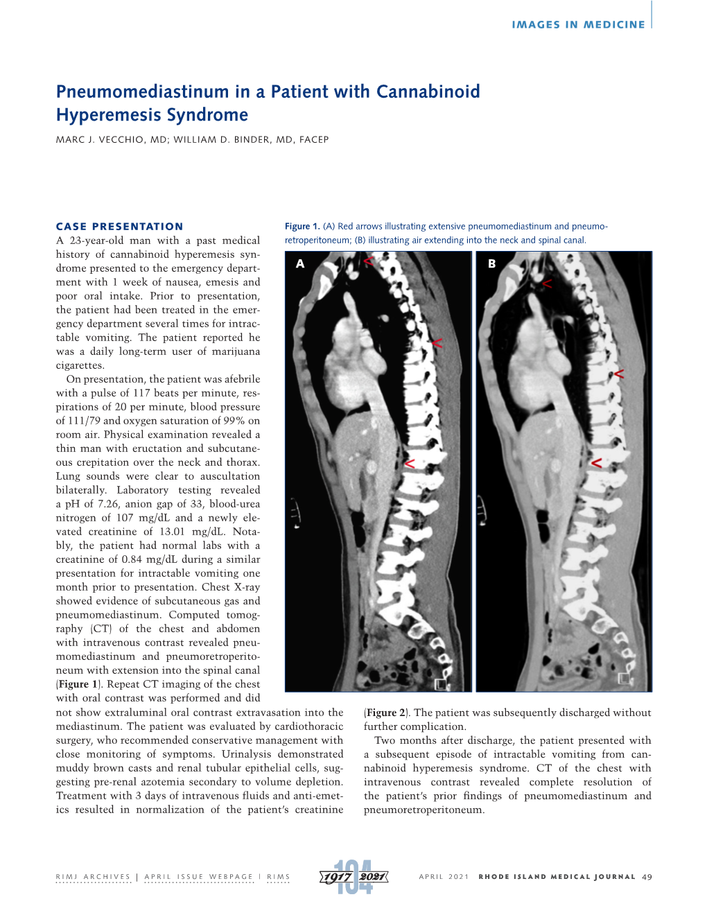 Pneumomediastinum in a Patient with Cannabinoid Hyperemesis Syndrome