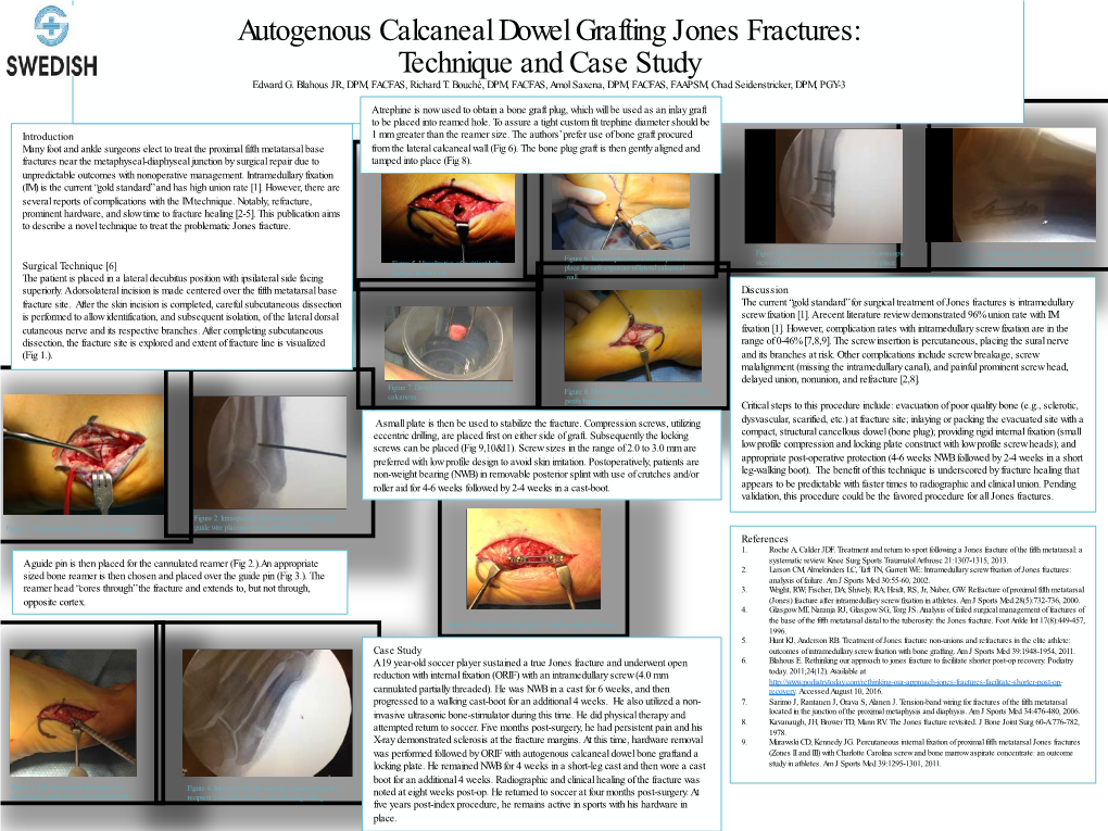 Autogenous Calcaneal Dowel Grafting Jones Fractures: Technique and Case Study Edward G