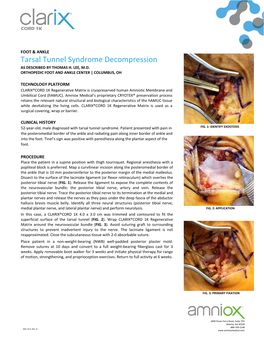 Tarsal Tunnel Syndrome Decompression AS DESCRIBED by THOMAS H