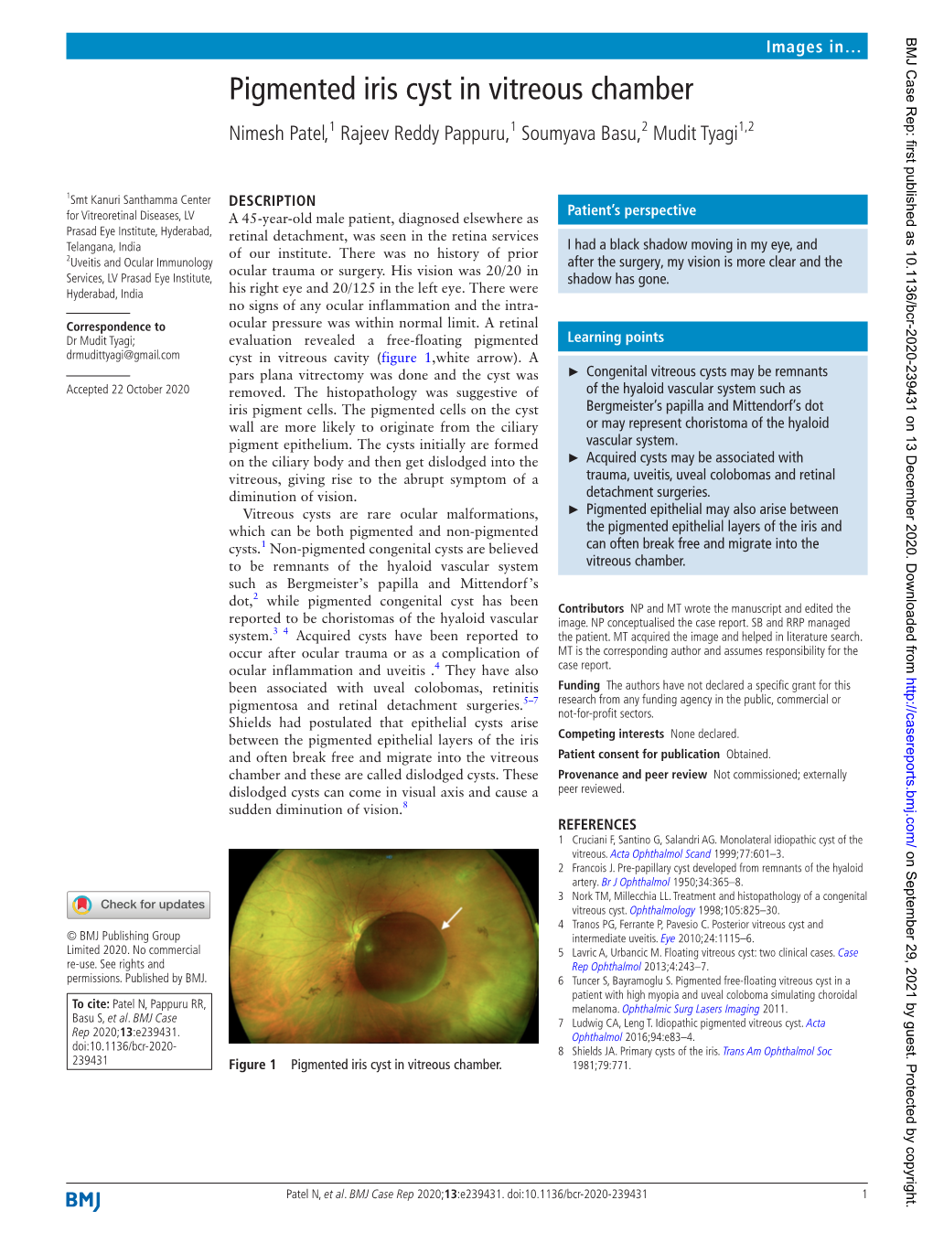 Pigmented Iris Cyst in Vitreous Chamber Nimesh Patel,1 Rajeev Reddy Pappuru,1 Soumyava Basu,2 Mudit Tyagi1,2