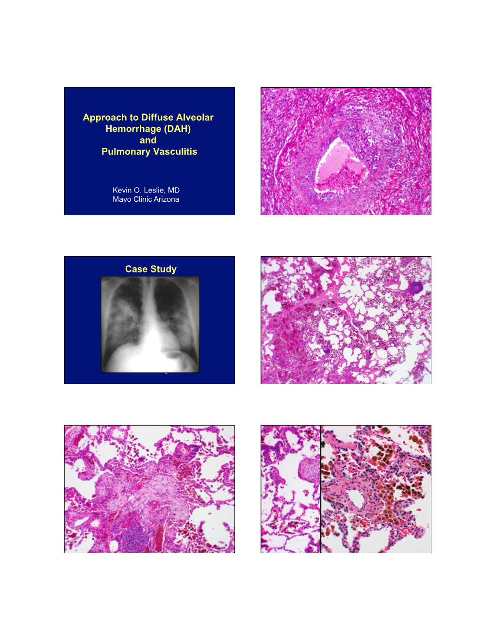 Approach to Diffuse Aveolar Hemorrhage (DAH) and Pulmonary