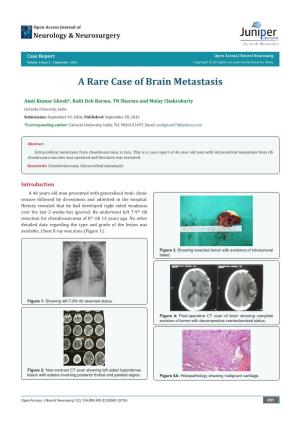 A Rare Case of Brain Metastasis