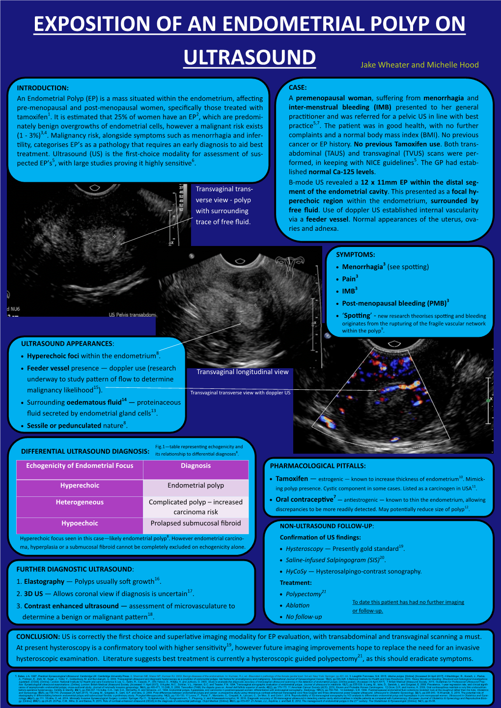 An Endometrial Polyp on Ultrasound