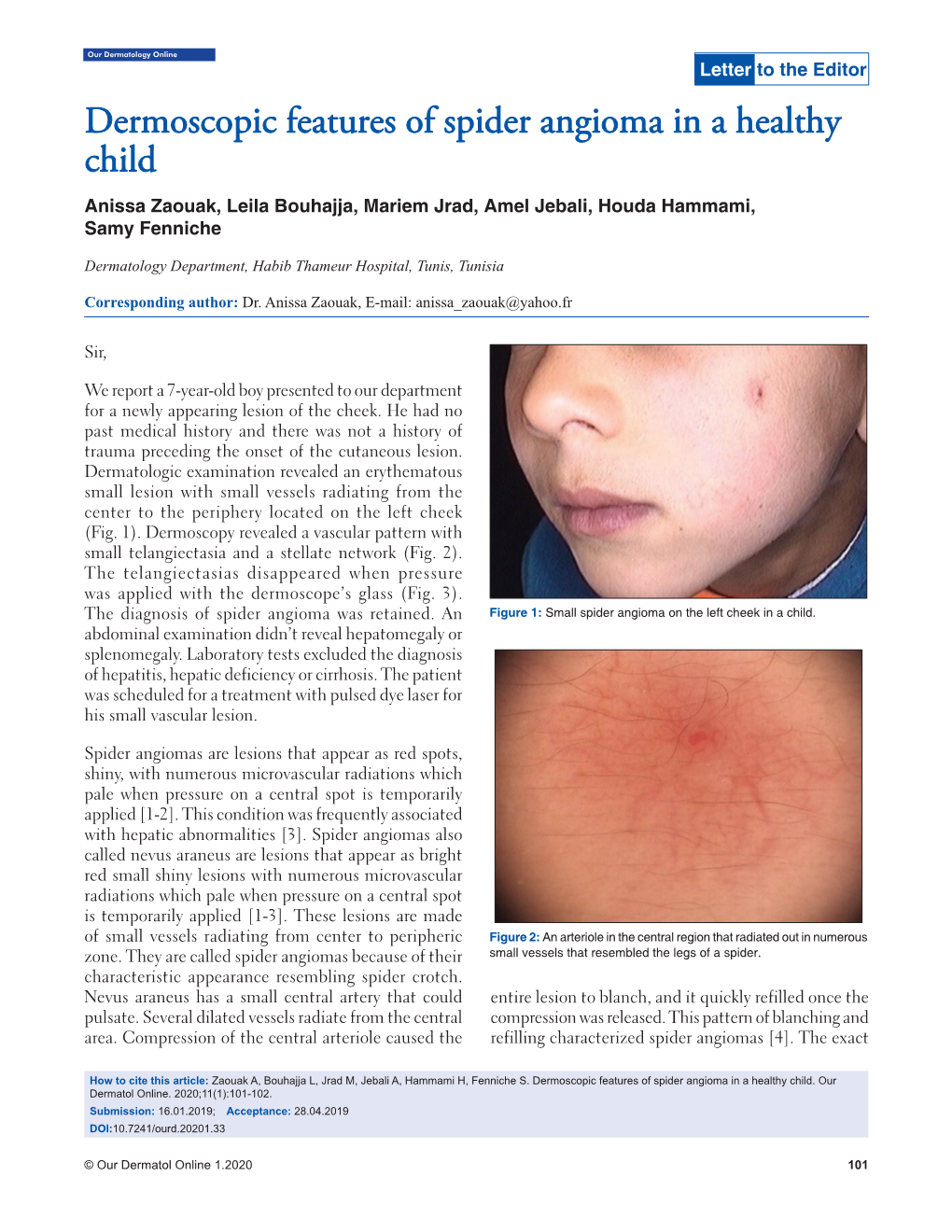 Dermoscopic Features of Spider Angioma in a Healthy Child - DocsLib